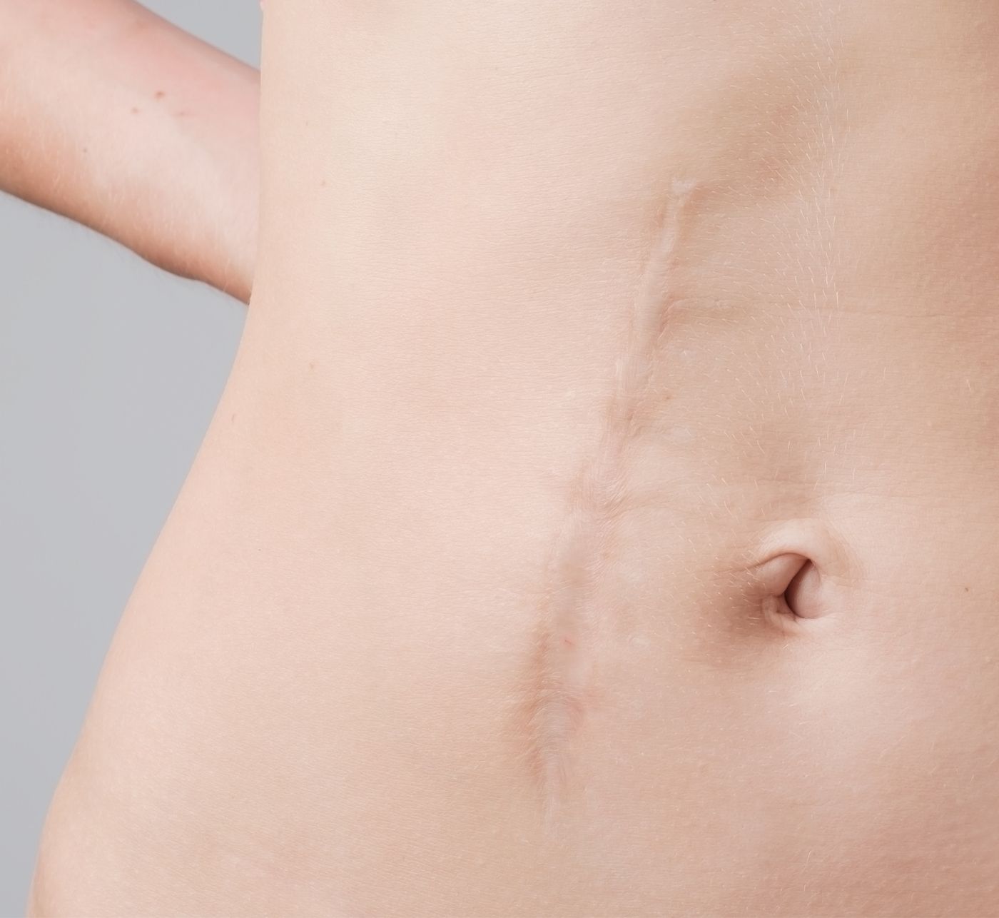 Come ridurre le aderenze post-chirurgiche - Inderma Clinic